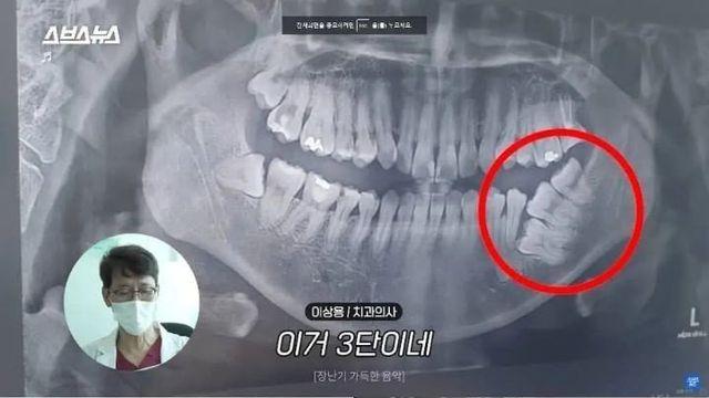 전설로 남은 사랑니ㄷㄷㄷㄷ. jpg		…