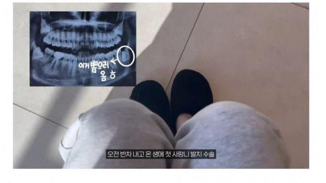 사랑님 뽑고 의사가 하지 말라는거 다 한 여자