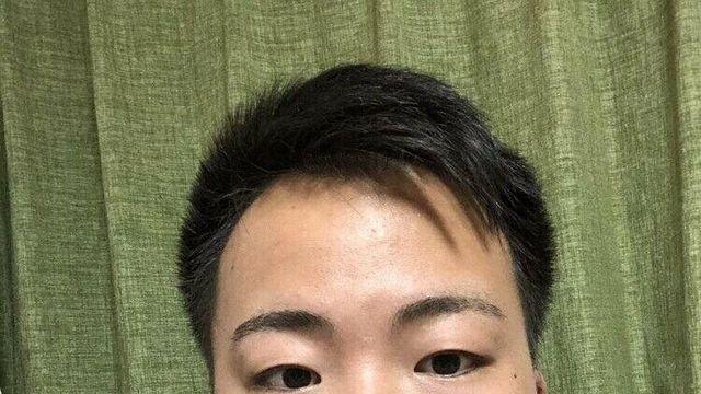 사랑니 한번에 네개 뽑은 일본인.jpg..