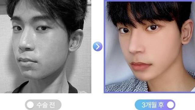 싱글벙글 성형 후 잘된 케이스들wow