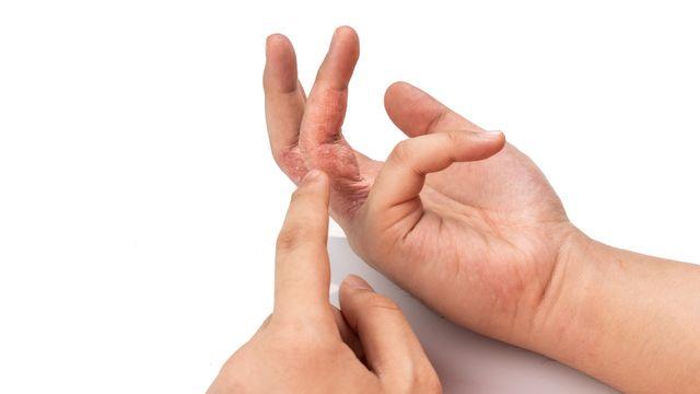 가렵고 진물까지... 장마철 대표 질환 ‘습진’ 예방하려면?