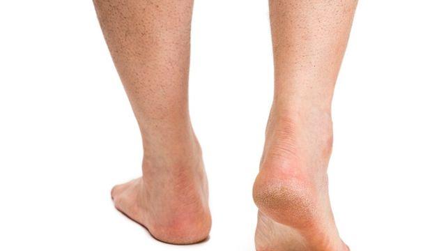 샌들의 계절 여름, 뒤꿈치 각질이 신경 쓰인다면?
