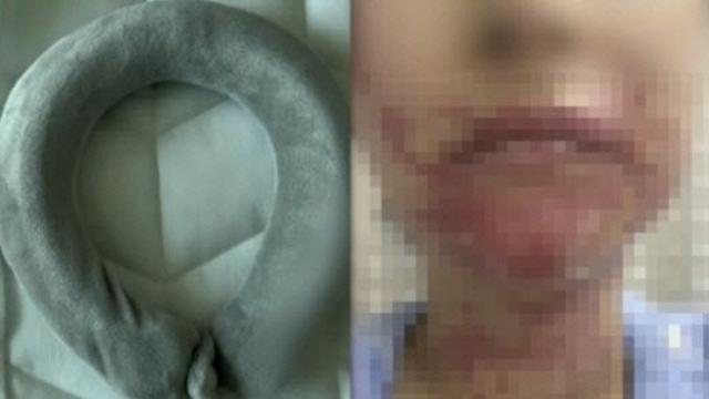 결혼식 앞두고...넥 워머 폭발해 예비 신부 얼굴에 화상