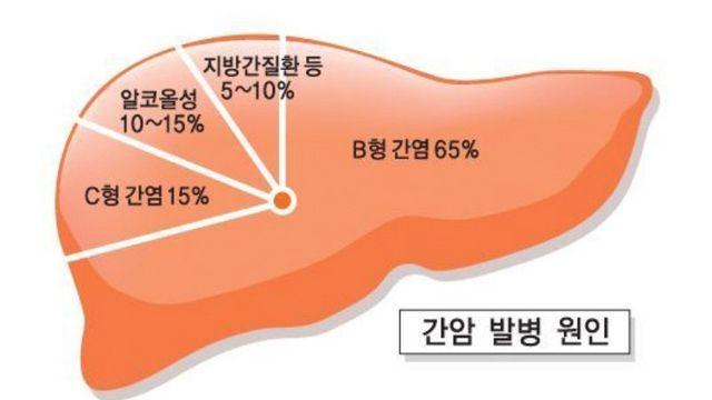 의외로 다들 모르는 간암의 주요원인