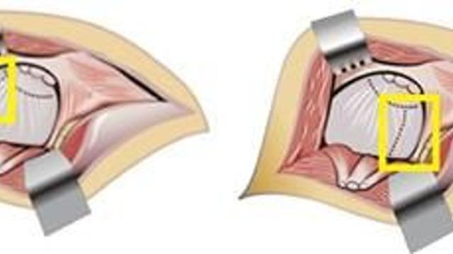새 인공 고관절 반치환술 ‘파이코’개발…위쪽 부위 근육과 연부조직 보존, 탈구 예방