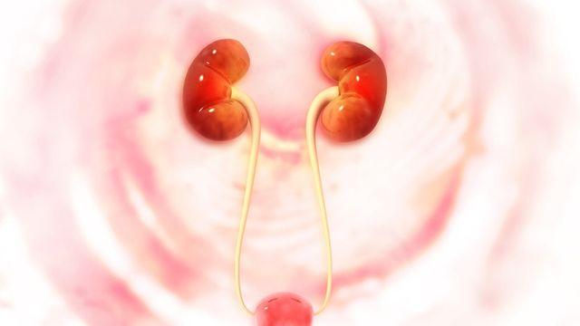 여름만 되면 찾아오는 '요로결석', 물 자주 드세요