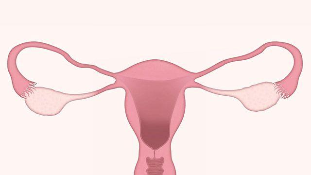 비만 증가‧출산 감소로 급증한 ‘자궁내막암’, 조기 진단하면 완치 가능
