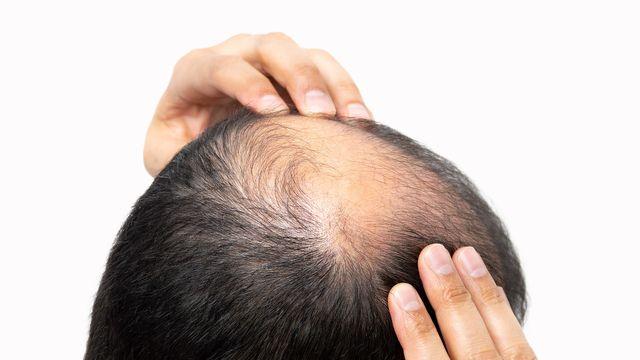 탈모인 천만 시대... 치료의 핵심은 ‘때’