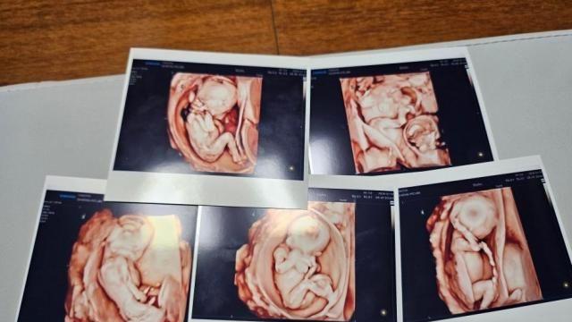 자연임신 다섯쌍둥이 출산...세계적으로 드물어