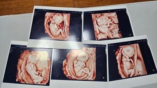 국내 최초 자연임신 다섯쌍둥이 분만 성공