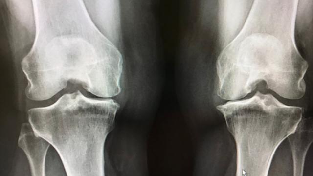 무릎은 왜 이렇게 쉽게 아플까?