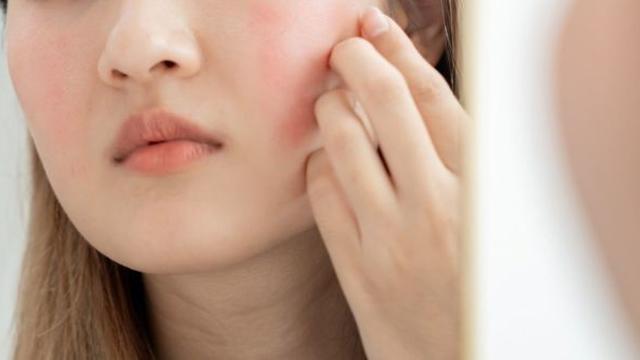 신경쓰이는 피부 트러블…알고 보니 '이것'이 원인일 수 있다