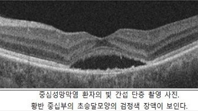 ‘중심성망막염’ 새 마이크로초레이저 치료법 개발