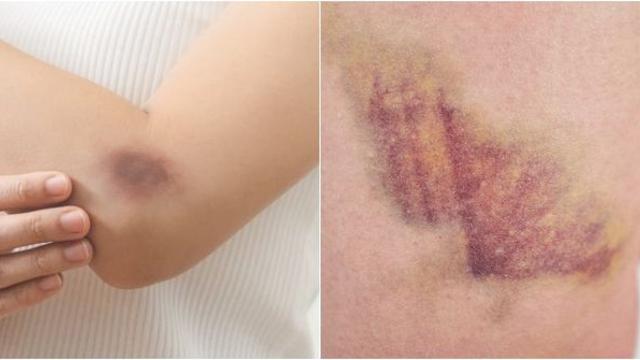 최근 몸에 모르는 멍 자국이 늘었다면…최근에 한 '이 행동'을 돌아봐야