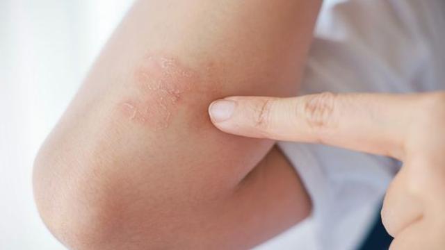 춥고 건조한 날씨에 찾아오는 불청객…건선에 좋은 음식과 나쁜 음식 5가지