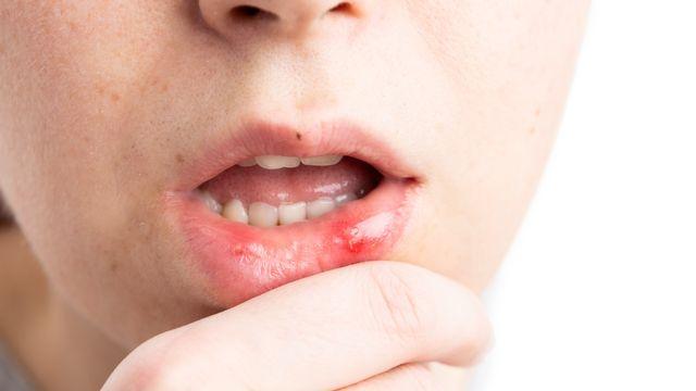 [건강물음표] 입안 통증 지속되면 '구강편평태선' 의심해야