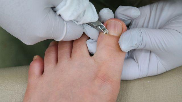 [헬스S] 살 파고드는 고통에 '헉'… 내성발톱, 이렇게 깎아보세요