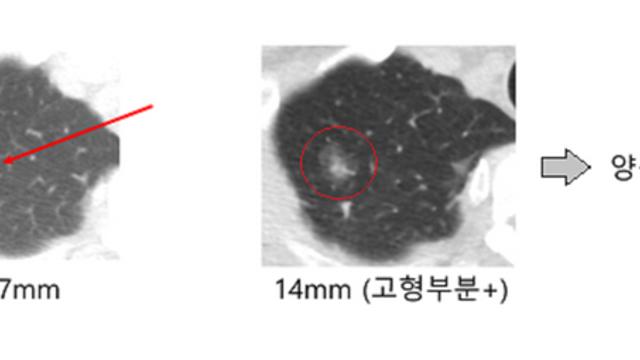 폐암 발전 가능한 간유리결절, 10년 뒤에도 자랄 수 있어