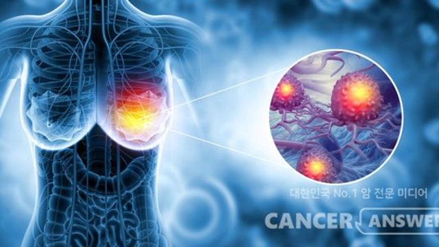 HER2 저발현 유방암, HER2 음성 유방암보다 재발률 높다