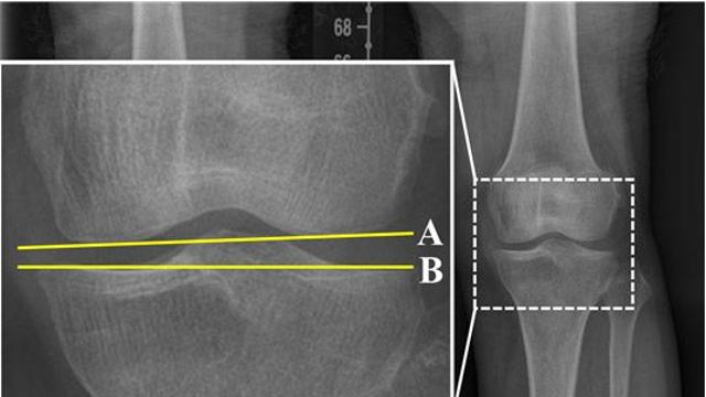 무릎 교정 절골술 후 악화한 ‘퇴행성 관절염’, 원인 찾았다