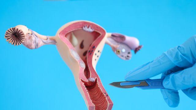 자궁경부암 전 단계 ‘자궁경부이형성증’ 10년 새 2배 증가