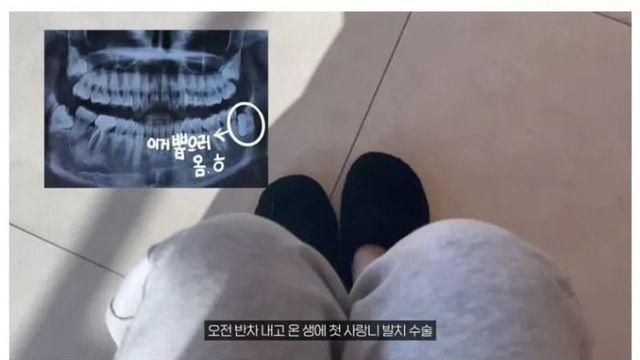 사랑니 뽑은 후 의사말 안듣고 마음대로 해버린 사람의 최후