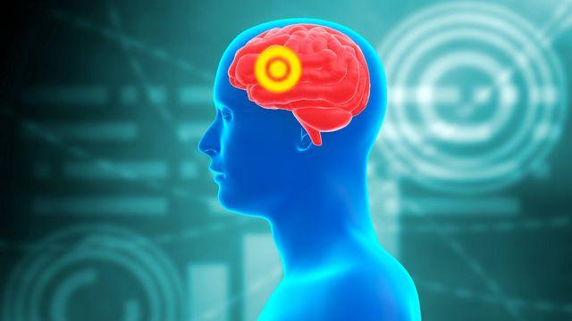 급성 뇌경색 환자, 지나친 ‘혈압 조절’ 피해야