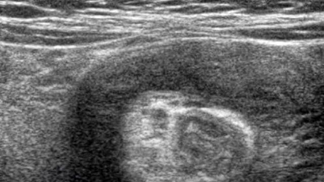 평소와 다른 아이의 복통, 응급질환 장중첩증 의심해야