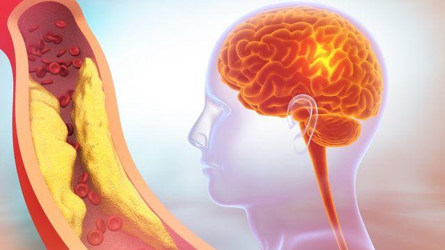 심장에서 뇌로 통하는 '이 혈관' 막힌 환자…최근 5년간 50% 이상 늘었다