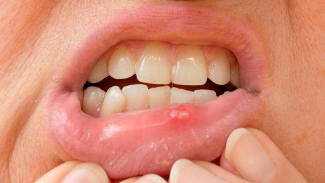 날이 추워지니 입안이 따끔따끔…겨울철 불청객 구내염, 빨리 낫는 방법은?