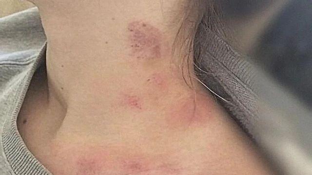 시위 나갔다가 목에 상처 입고 온 여친보고 화난 남친