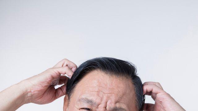 [헬스S] 습진 있는 '중년 남성'이라면… '지루성 피부염' 의심