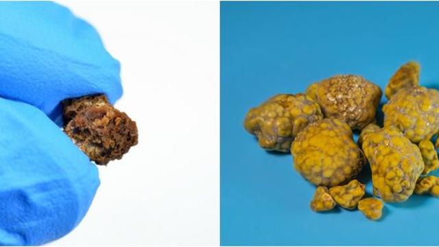 극심한 고통 유발하는 '몸 속의 돌'…빼냈다고 안심해선 안 된다