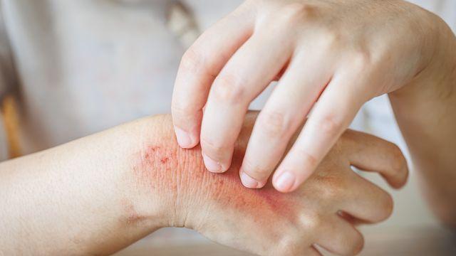 [건강물음표] 겨울철 꿈틀대는 '수두-대상포진 바이러스', 백신으로 막는다