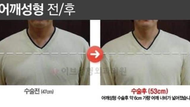 신개념 수술.jpg,,