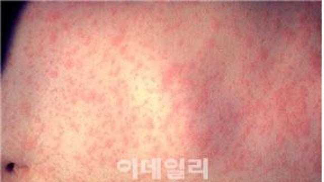 전세계 벌써 31만명 감염 이병…주의하려면