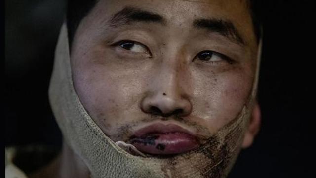 붕대 감은 북한군 포로 