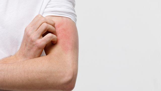 [헬스S] 긁으면 글씨가 써지는 붉은 피부… '피부묘기증' 의심해야