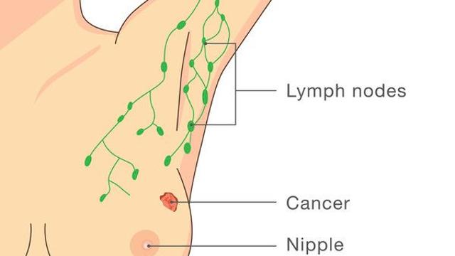 유방암 수술전 항암치료, 림프절 전이 가능성 높다