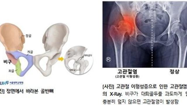 2차골화중심, 비구 발달에 미치는 영향 첫 확인…소아청소년 132명 CT 분석. 결과