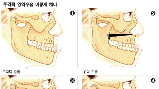 얼굴뼈 수술에 대해 알아보자