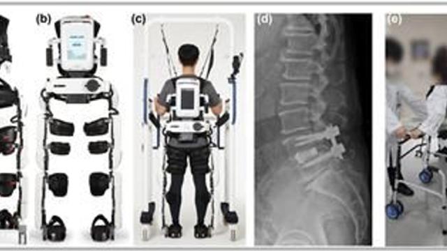 척추 수술 환자 대상 로봇 보조 보행 훈련…일상생활 수행 능력 평균 39% 향상