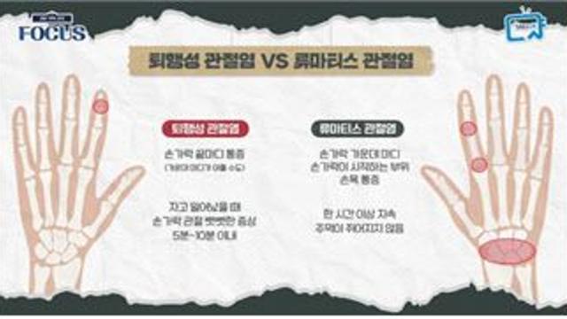 관절에 생긴 만성염증, 류마티스 관절염의 관리는 이렇게?