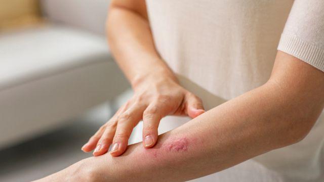 [헬스S] 고통 극심한 대상포진… 어릴 적 수두 앓았다면 '주의'