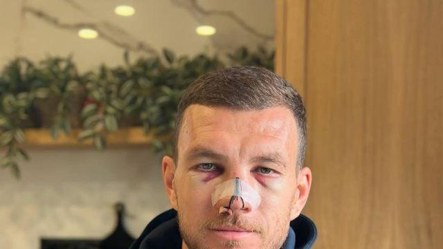 ‘전 맨시티 레전드’ ST, 월드컵 예선 중 끔찍한 얼굴 부상…발로텔리 “모습 멋지네” 격려