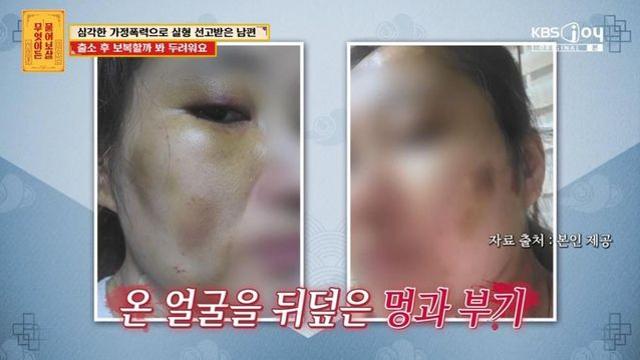 물고문→갈비뼈 4대 부러뜨린 남편, 이유는 “100명 외도 망상” (‘물어보살’)