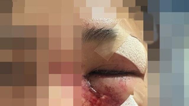 '이별통보' 여친폭행, 광대뼈 함몰…母에 