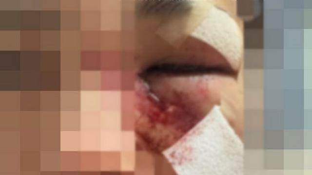 16살 연하 여친 폭행한 남친, 광대뼈 함몰돼… 