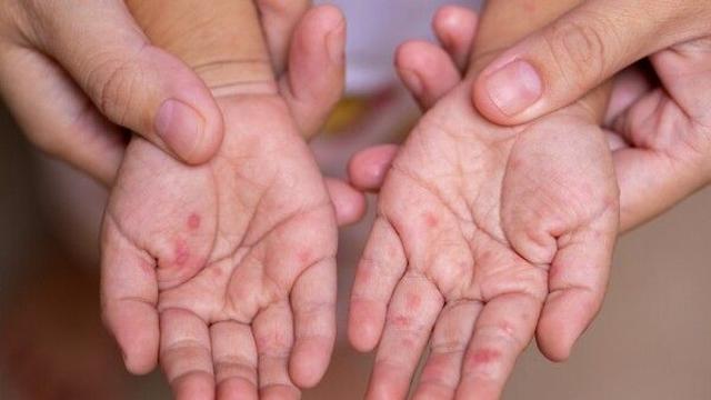 thumbimg