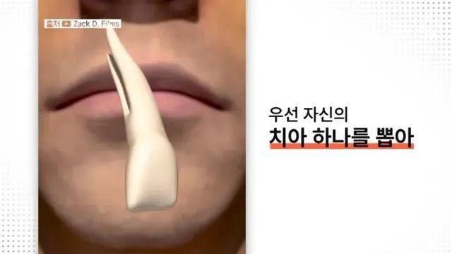눈에 치아를 넣어 시력을 회복하는 수술,,